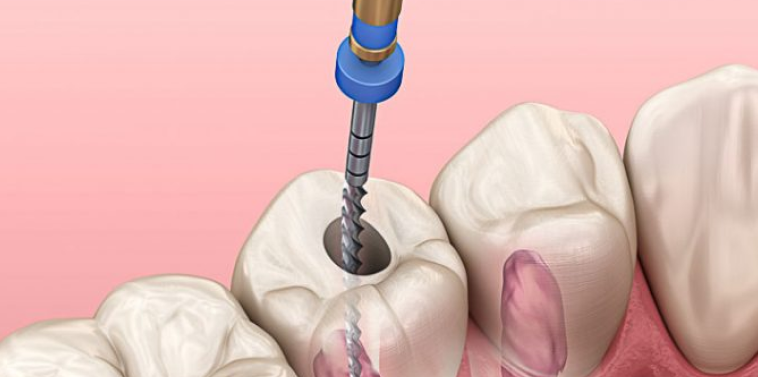 Endodontia (Tratamento de Canal)